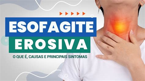 esofagite não erosiva - ser ou não ser eis a questão